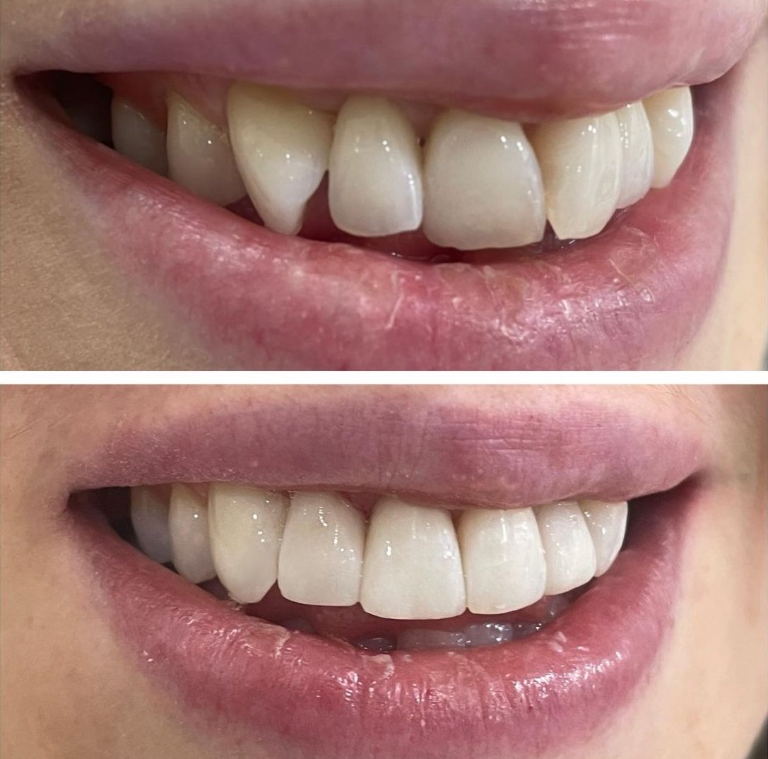 Artful Precision: The Delicate Craft of Composite Bonding in Dentistry